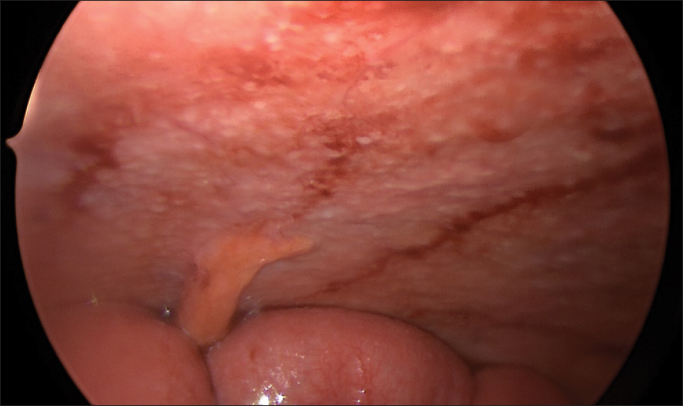 Intraoperative image showing peritoneal nodules and thickening of the small bowel.